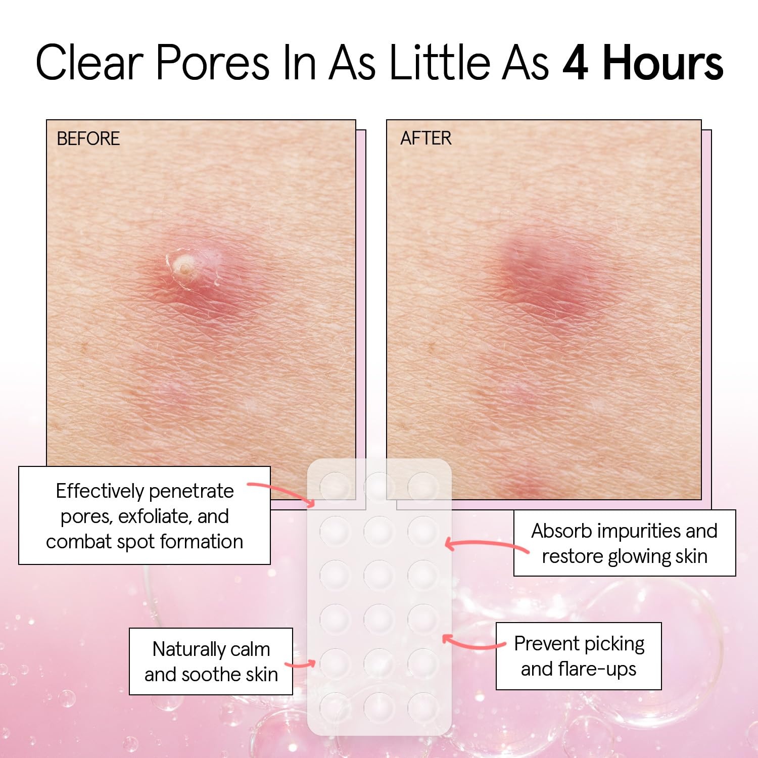 image:imagegrace amp stella Award Winning Pore Strip Pimple Patches for Face36 Count Pack of 1
