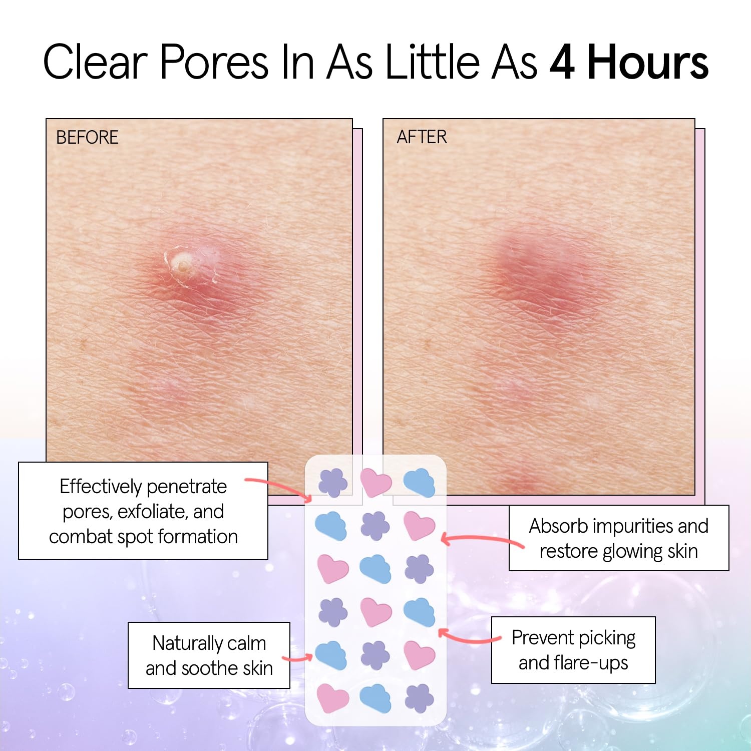 image:imagegrace amp stella Award Winning Pore Strip Pimple Patches for Face72 Count Pack of 1