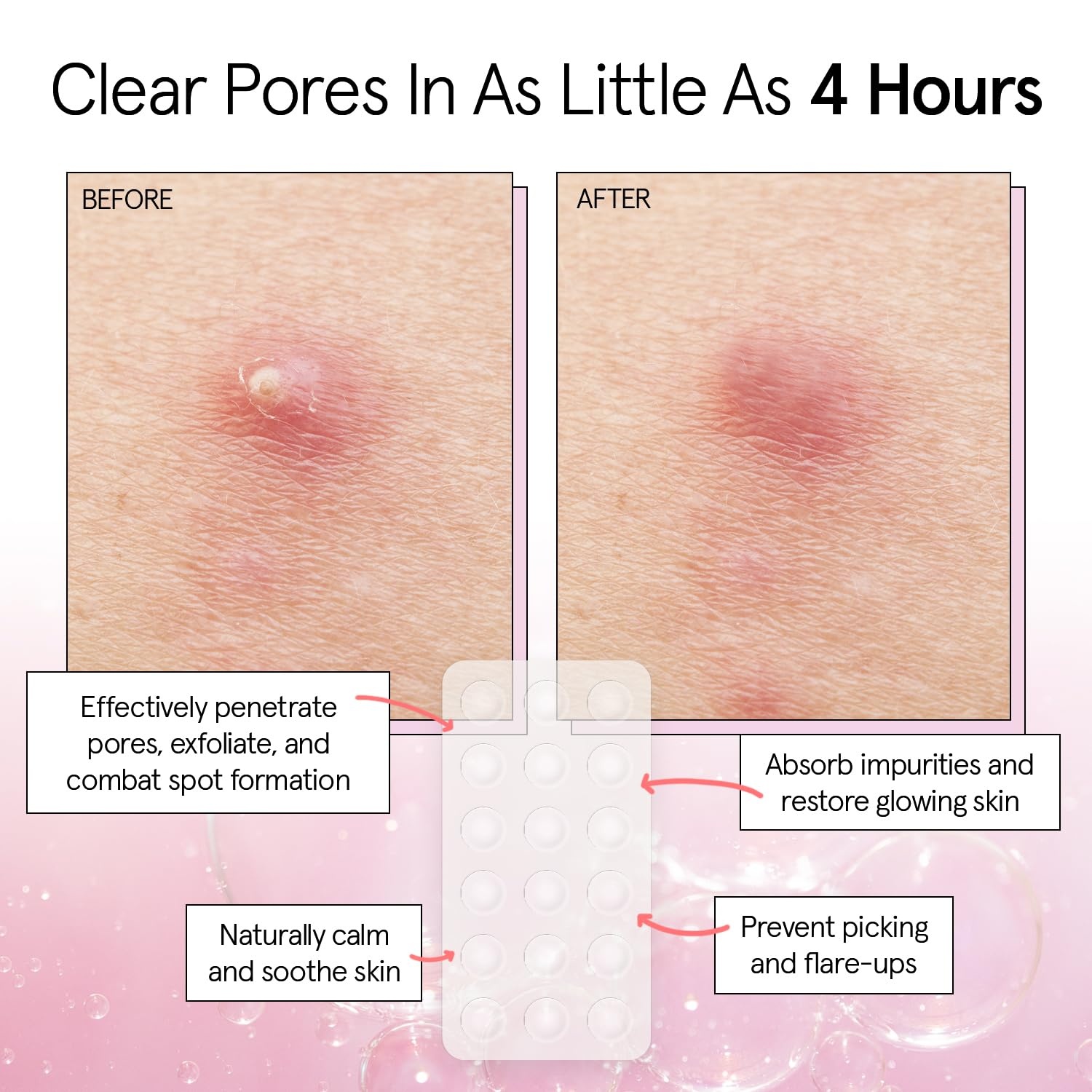 image:imagegrace amp stella Award Winning Pore Strip Pimple Patches for Face72 Count Pack of 1