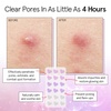 grace & stella Award Winning Pore Strip – Pimple Patches for Face(36 Count ( Pack of 1))